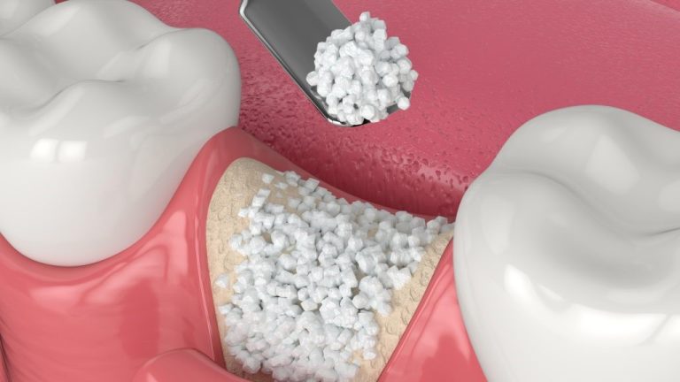 ایمپلنت دندان و پیوند استخوان